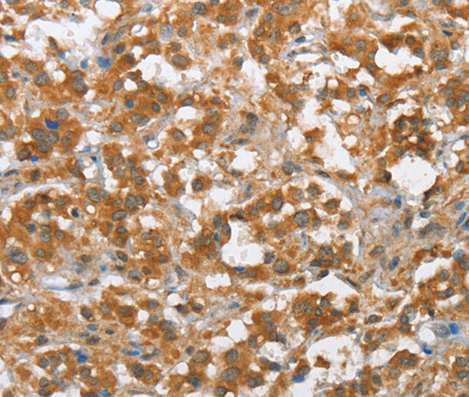 Immunohistochemistry of paraffin-embedded Human thyroid cancer tissue using MLH1 Polyclonal Antibody at dilution 1:60