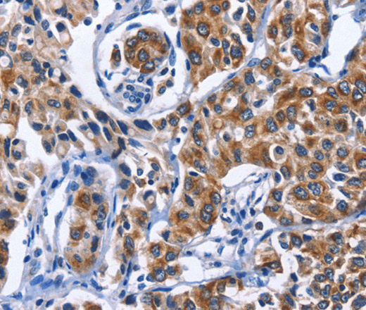 Immunohistochemistry of paraffin-embedded Human lung cancer tissue using MYH1 Polyclonal Antibody at dilution 1:40