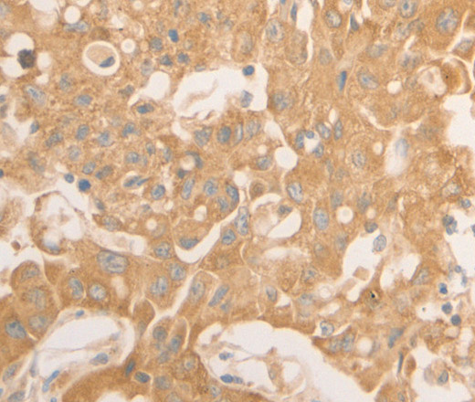 Immunohistochemistry of paraffin-embedded Human lung cancer using NAP1L1 Polyclonal Antibody at dilution of 1:50