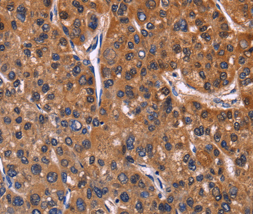 Immunohistochemistry of paraffin-embedded Human liver cancer tissue using NFATC3 Polyclonal Antibody at dilution 1:60