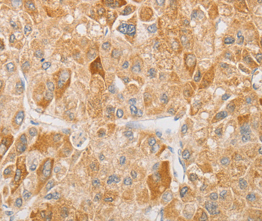 Immunohistochemistry of paraffin-embedded Human liver cancer tissue using NGF Polyclonal Antibody at dilution 1:40