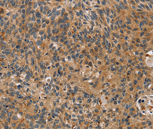 Immunohistochemistry of paraffin-embedded Human esophagus cancer tissue using TAC1 Polyclonal Antibody at dilution 1:25