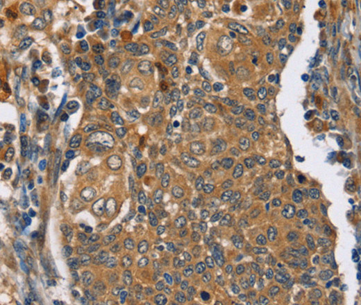 Immunohistochemistry of paraffin-embedded Human cervical cancer tissue using TAC1 Polyclonal Antibody at dilution 1:25