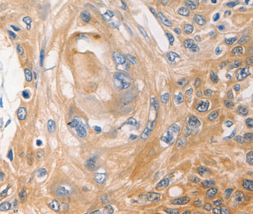 Immunohistochemistry of paraffin-embedded Human esophagus cancer using NME1 Polyclonal Antibody at dilution of 1:40