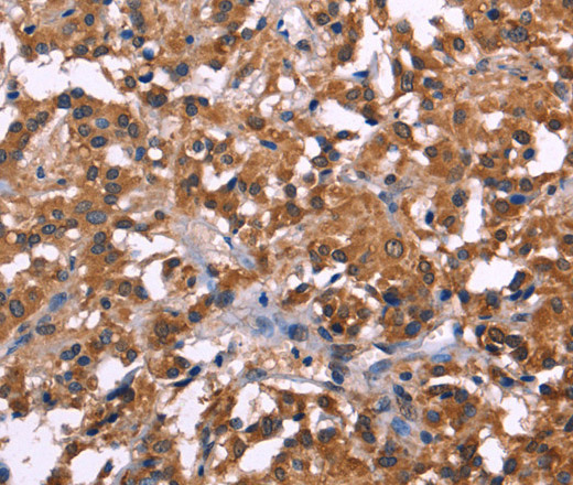 Immunohistochemistry of paraffin-embedded Human thyroid cancer tissue using NOS2 Polyclonal Antibody at dilution 1:30