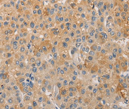 Immunohistochemistry of paraffin-embedded Human liver cancer using NFE2L1 Polyclonal Antibody at dilution of 1:30