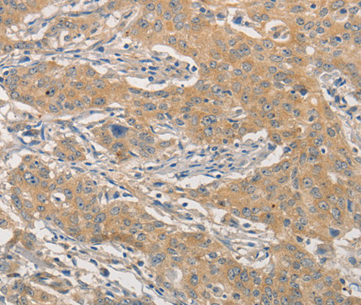 Immunohistochemistry of paraffin-embedded Human gastric cancer using NFE2L1 Polyclonal Antibody at dilution of 1:30