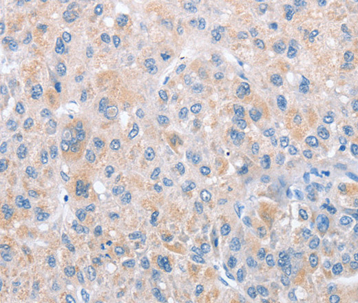 Immunohistochemistry of paraffin-embedded Human liver cancer tissue using PARD6A Polyclonal Antibody at dilution 1:60