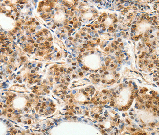 Immunohistochemistry of paraffin-embedded Human thyroid cancer using PDCD6 Polyclonal Antibody at dilution of 1:30