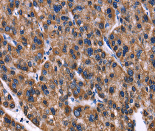 Immunohistochemistry of paraffin-embedded Human liver cancer using PHB Polyclonal Antibody at dilution of 1:40