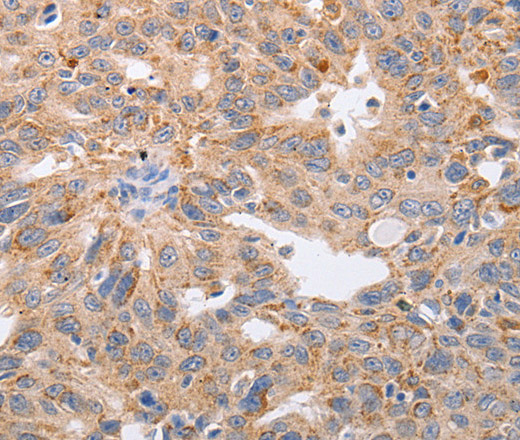 Immunohistochemistry of paraffin-embedded Human ovarian cancer tissue using PPP1CB Polyclonal Antibody at dilution 1:40