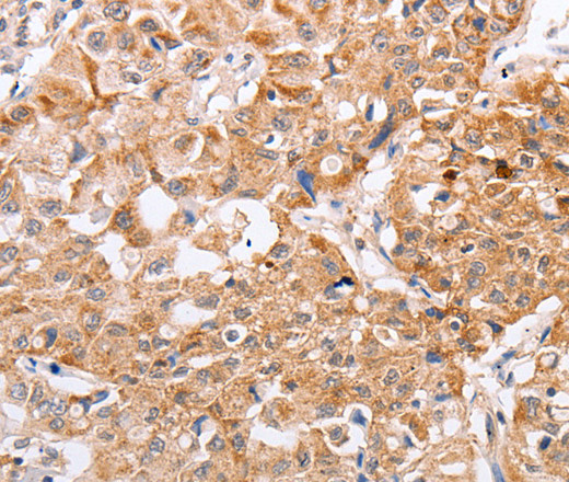 Immunohistochemistry of paraffin-embedded Human lung cancer tissue using PPP1CB Polyclonal Antibody at dilution 1:40