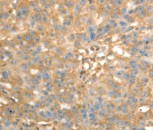 Immunohistochemistry of paraffin-embedded Human ovarian cancer using PSMD9 Polyclonal Antibody at dilution of 1:40