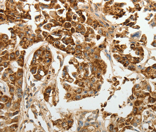 Immunohistochemistry of paraffin-embedded Human lung cancer using E-Selectin Polyclonal Antibody at dilution of 1:30