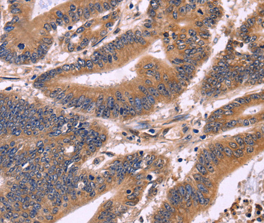 Immunohistochemistry of paraffin-embedded Human colon cancer tissue using S100A13 Polyclonal Antibody at dilution 1:40