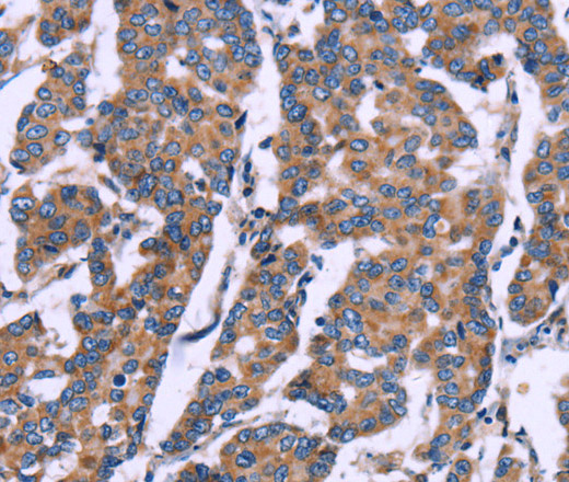 Immunohistochemistry of paraffin-embedded Human breast cancer tissue using ZEB2 Polyclonal Antibody at dilution 1:60