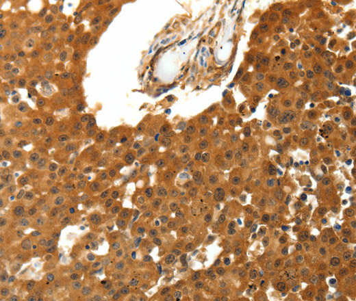 Immunohistochemistry of paraffin-embedded Human breast cancer using SKP1 Polyclonal Antibody at dilution of 1:30