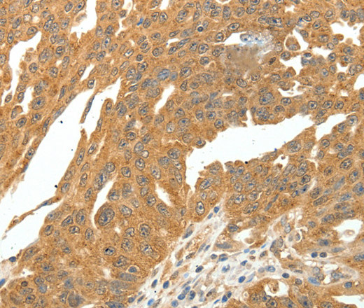 Immunohistochemistry of paraffin-embedded Human ovarian cancer using SKP1 Polyclonal Antibody at dilution of 1:30