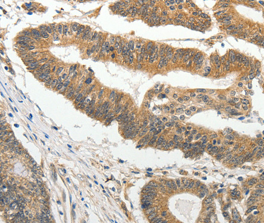 Immunohistochemistry of paraffin-embedded Human colon cancer tissue using SLC4A4 Polyclonal Antibody at dilution 1:50