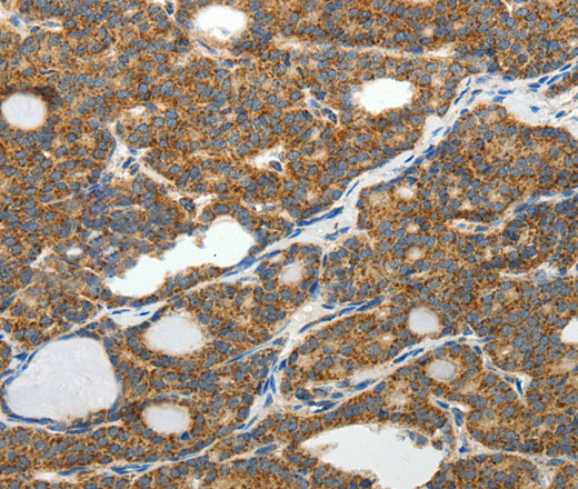 Immunohistochemistry of paraffin-embedded Human thyroid cancer tissue using SLC12A4 Polyclonal Antibody at dilution 1:30