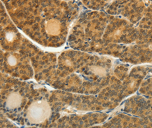 Immunohistochemistry of paraffin-embedded Human thyroid cancer tissue using SOCS5 Polyclonal Antibody at dilution 1:35