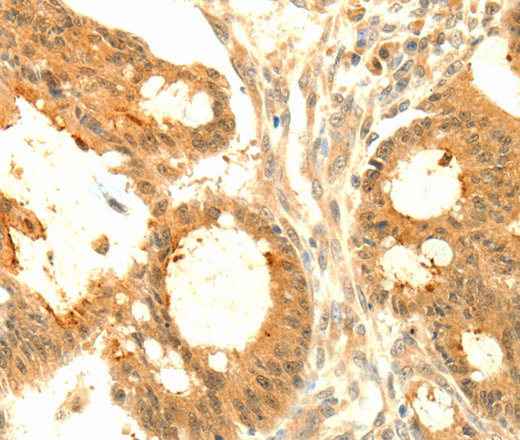 Immunohistochemistry of paraffin-embedded Human colon cancer tissue using SOCS6 Polyclonal Antibody at dilution 1:50