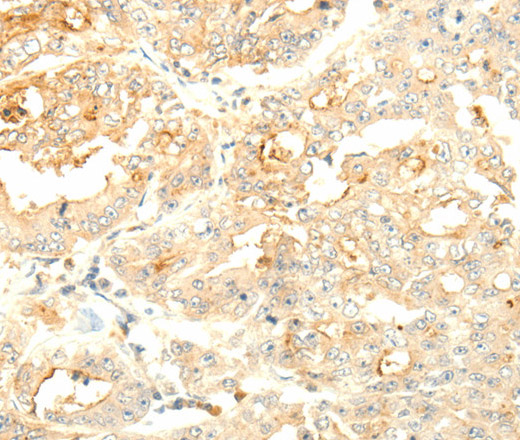 Immunohistochemistry of paraffin-embedded Human gastric cancer tissue using SOCS6 Polyclonal Antibody at dilution 1:50