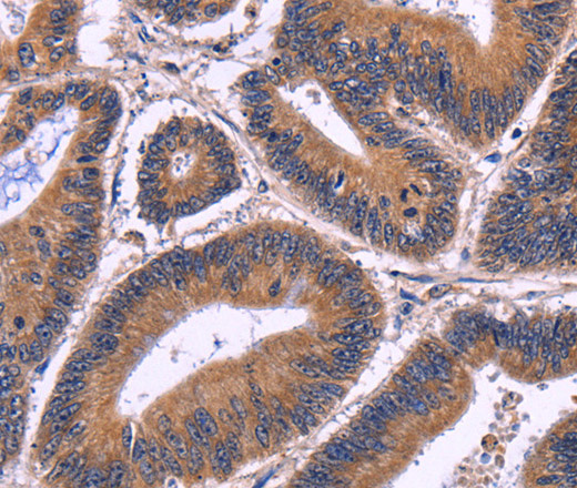 Immunohistochemistry of paraffin-embedded Human colon cancer tissue using SPATA7 Polyclonal Antibody at dilution 1:30