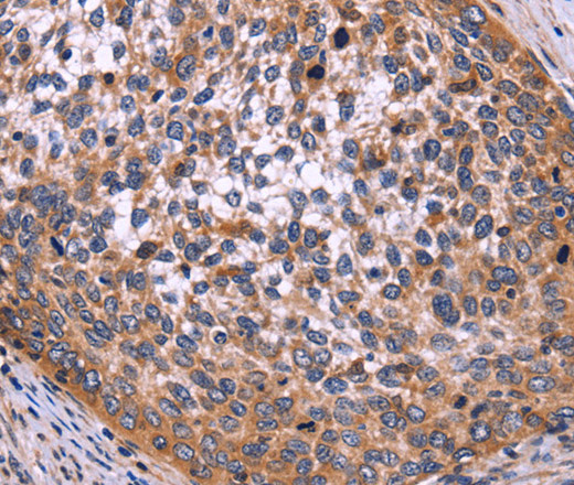 Immunohistochemistry of paraffin-embedded Human cervical cancer tissue using SPATA7 Polyclonal Antibody at dilution 1:30