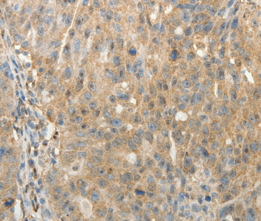 Immunohistochemistry of paraffin-embedded Human ovarian cancer using SULT1E1 Polyclonal Antibody at dilution of 1:30