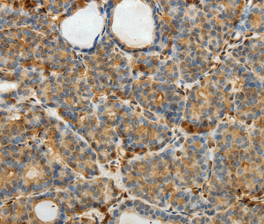 Immunohistochemistry of paraffin-embedded Human thyroid cancer using SULT1E1 Polyclonal Antibody at dilution of 1:30