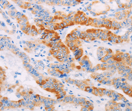 Immunohistochemistry of paraffin-embedded Human thyroid cancer using MAP4K3 Polyclonal Antibody at dilution of 1:30