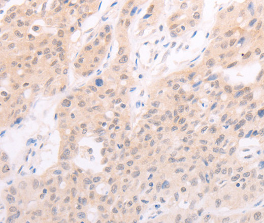 Immunohistochemistry of paraffin-embedded Human lung cancer using F7 Polyclonal Antibody at dilution of 1:40