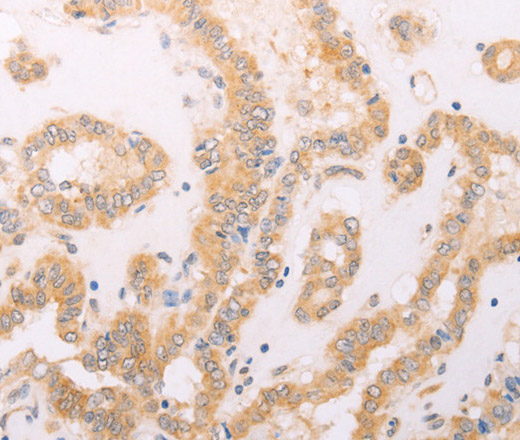 Immunohistochemistry of paraffin-embedded Human thyroid cancer using F7 Polyclonal Antibody at dilution of 1:40