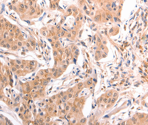 Immunohistochemistry of paraffin-embedded Human lung cancer tissue using TNF beta Polyclonal Antibody at dilution 1:50