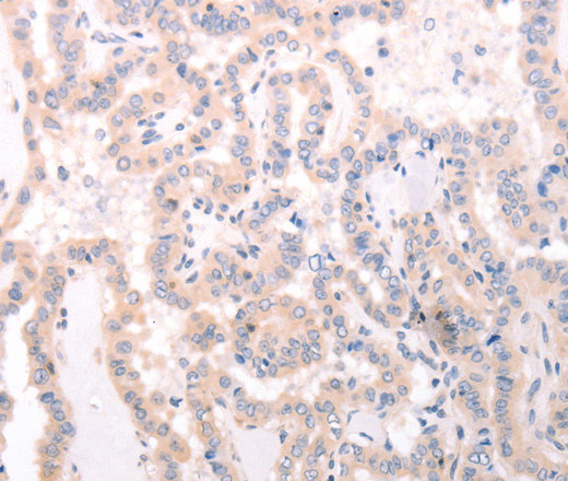 Immunohistochemistry of paraffin-embedded Human thyroid cancer using TRAF3IP1 Polyclonal Antibody at dilution of 1:70