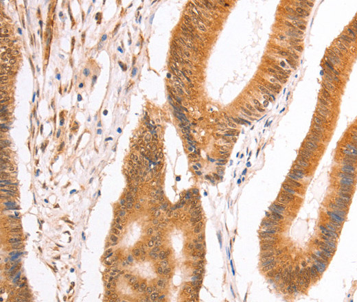 Immunohistochemistry of paraffin-embedded Human colon cancer tissue using TAX1BP1 Polyclonal Antibody at dilution 1:40