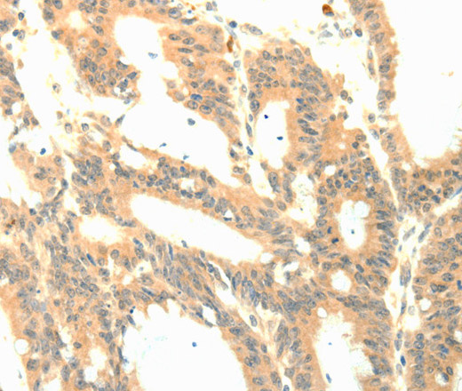 Immunohistochemistry of paraffin-embedded Human colon cancer tissue using P23 Polyclonal Antibody at dilution 1:50