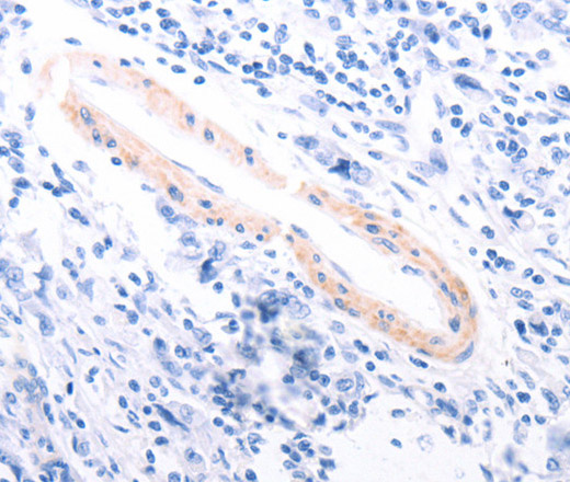 Immunohistochemistry of paraffin-embedded Human gastric cancer using TPM1 Polyclonal Antibody at dilution of 1:80