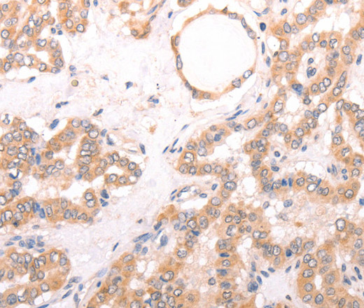 Immunohistochemistry of paraffin-embedded Human thyroid cancer tissue using TRPV4 Polyclonal Antibody at dilution 1:40