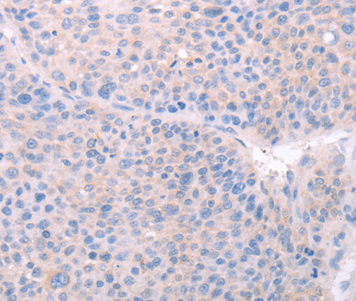 Immunohistochemistry of paraffin-embedded Human liver cancer using SPATA6 Polyclonal Antibody at dilution of 1:40