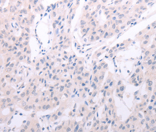 Immunohistochemistry of paraffin-embedded Human lung cancer using SPATA6 Polyclonal Antibody at dilution of 1:40