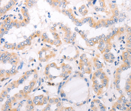 Immunohistochemistry of paraffin-embedded Human thyroid cancer tissue using CIDEB Polyclonal Antibody at dilution 1:50