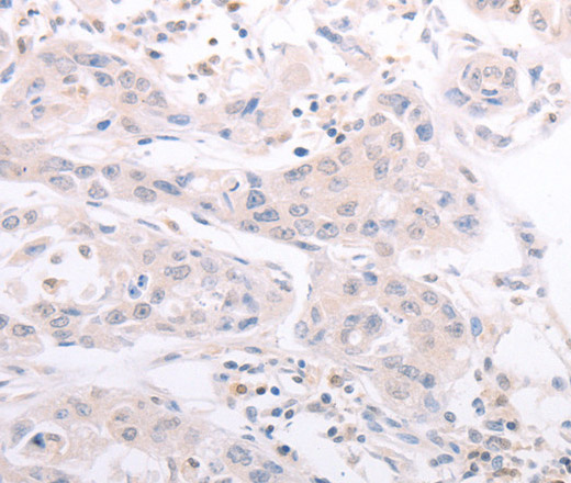 Immunohistochemistry of paraffin-embedded Human lung cancer tissue using CIDEB Polyclonal Antibody at dilution 1:50