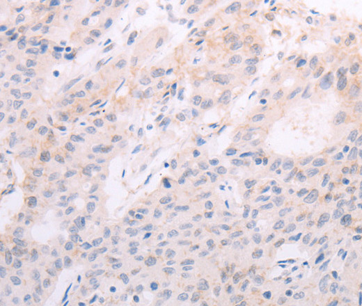 Immunohistochemistry of paraffin-embedded Human liver cancer tissue using TSHR Polyclonal Antibody at dilution 1:50