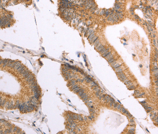 Immunohistochemistry of paraffin-embedded Human colon cancer using NAMPT Polyclonal Antibody at dilution of 1:30