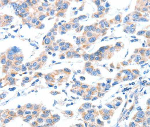 Immunohistochemistry of paraffin-embedded Human breast cancer tissue using XBP1 Polyclonal Antibody at dilution 1:70