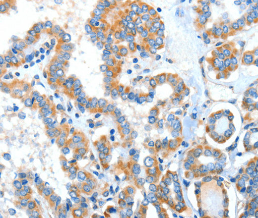 Immunohistochemistry of paraffin-embedded Human thyroid cancer tissue using XBP1 Polyclonal Antibody at dilution 1:70