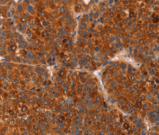 Immunohistochemistry of paraffin-embedded Human liver cancer tissue using GC Polyclonal Antibody at dilution 1:30