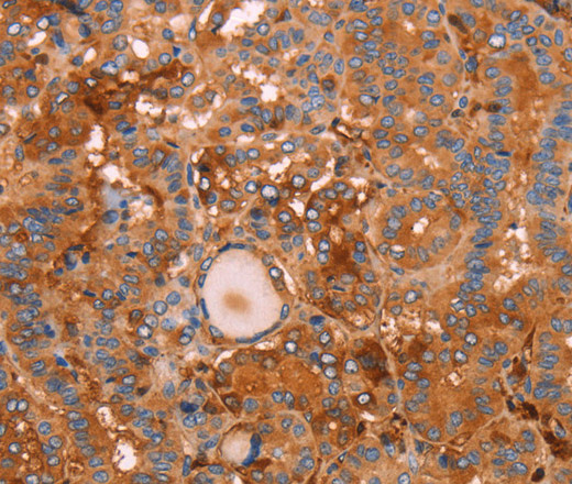 Immunohistochemistry of paraffin-embedded Human thyroid cancer tissue using GC Polyclonal Antibody at dilution 1:30